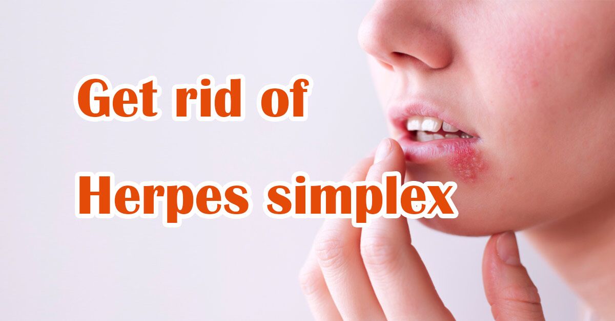 herpes simplex virus how to get rid of it
